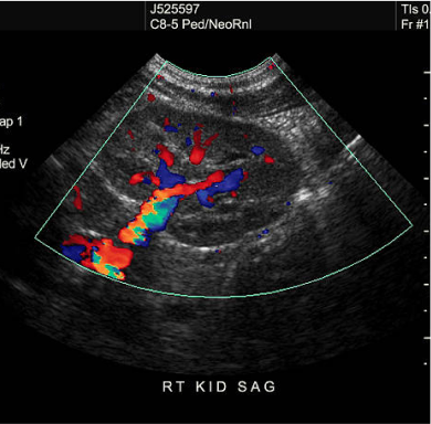 Vascular Ultrasound